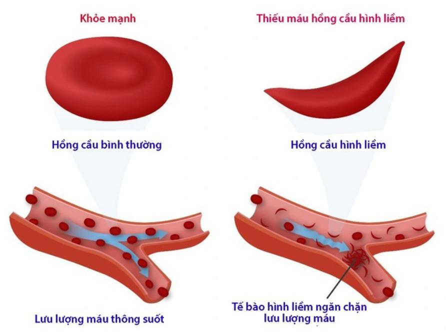 Bệnh Hồng Cầu Hình Liềm