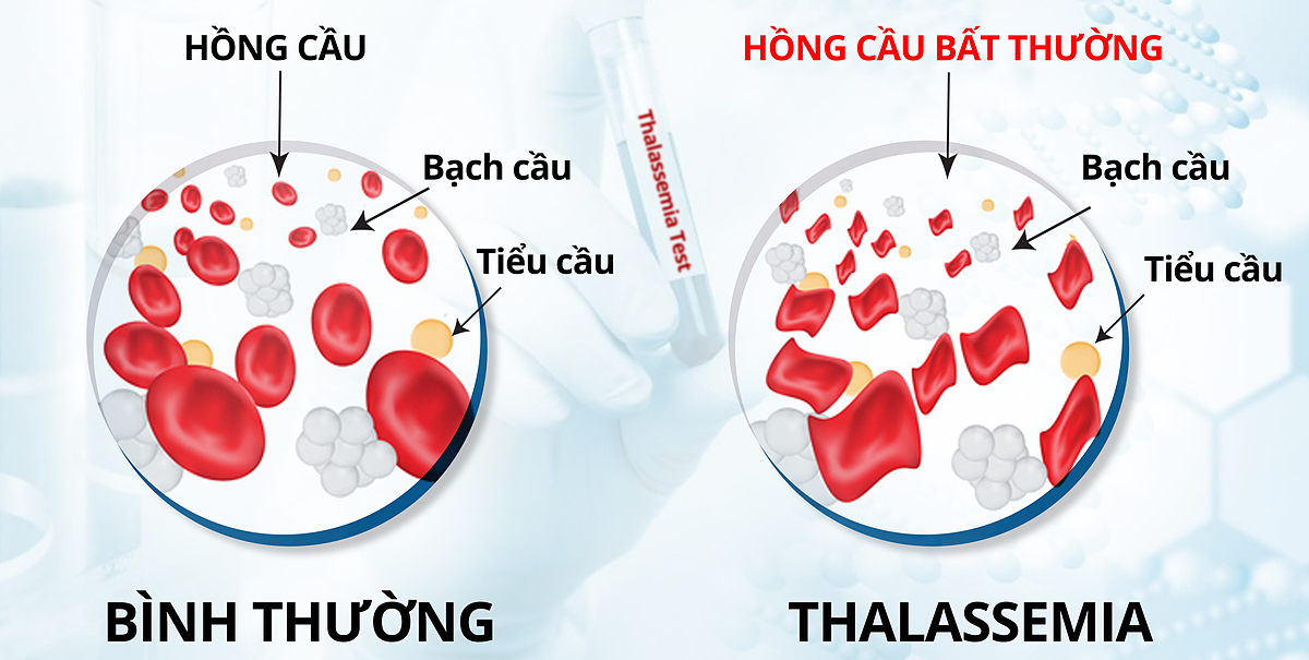 Bệnh Thalassemia